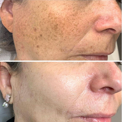 Freckle Whitening Serum
