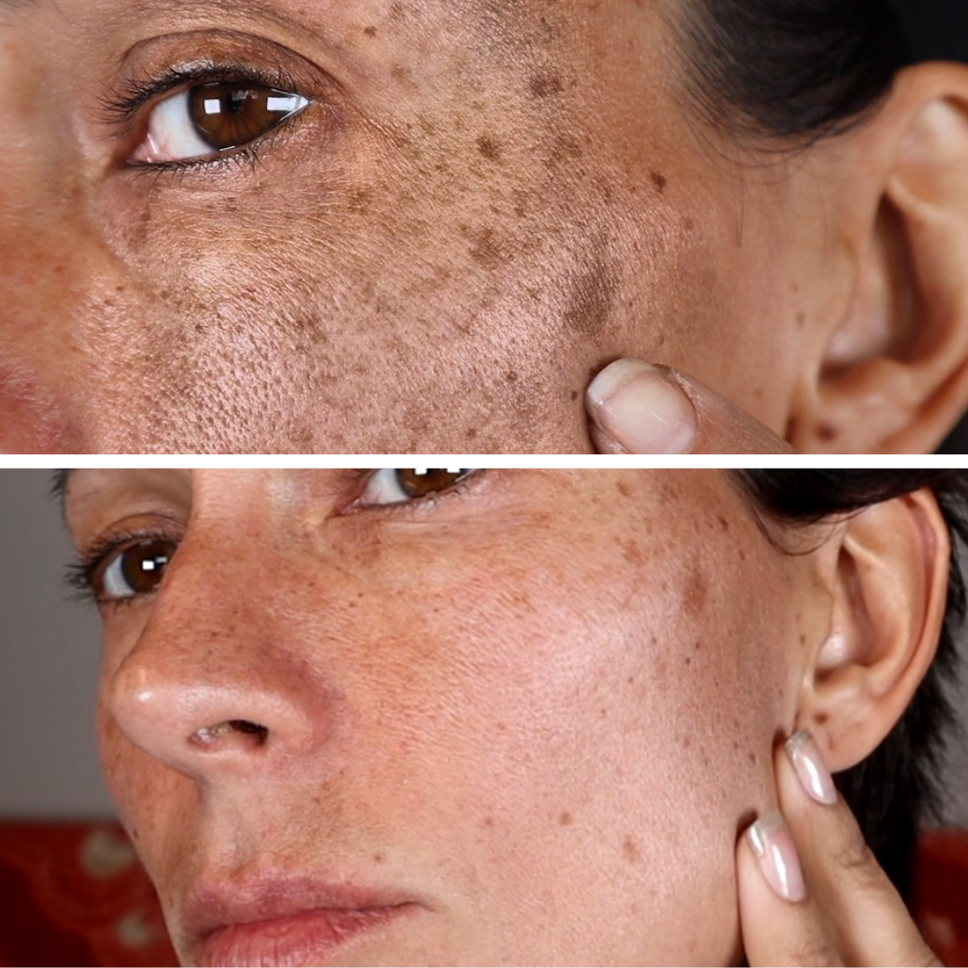 All Natural Skin Tag Remover Serum