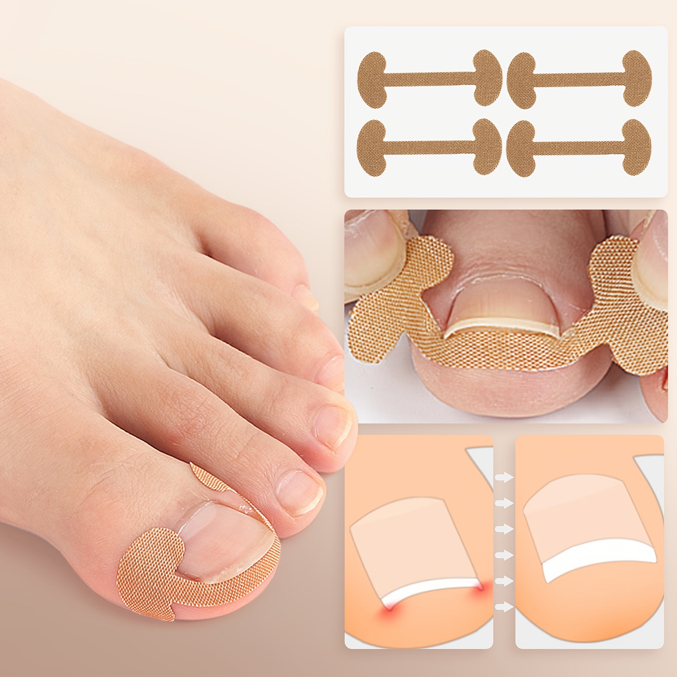 Toenail Correction Strips