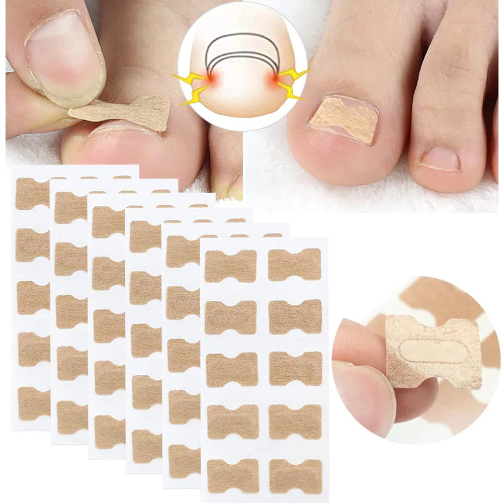 Toenail Correction Strips